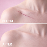 Silicone Scar Repair Patch